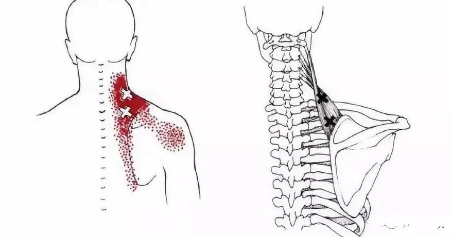 此肩胛骨内角显性应激点按压时吋感疼痛放射至同侧颈项,前额,甚至颈部