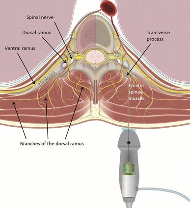 超声引导竖脊肌平面阻滞科普第二弹