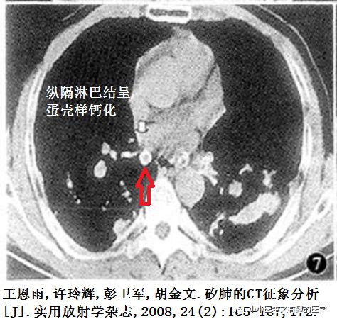 case1:结核胸膜,纵隔淋巴结,都会蛋壳样钙化!自己动手,丰衣足食!