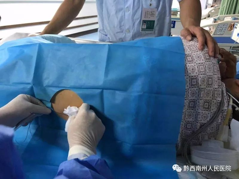 重症胰腺炎患者早期实行胸段硬膜外持续镇痛ct定位下坏死感染性胰腺