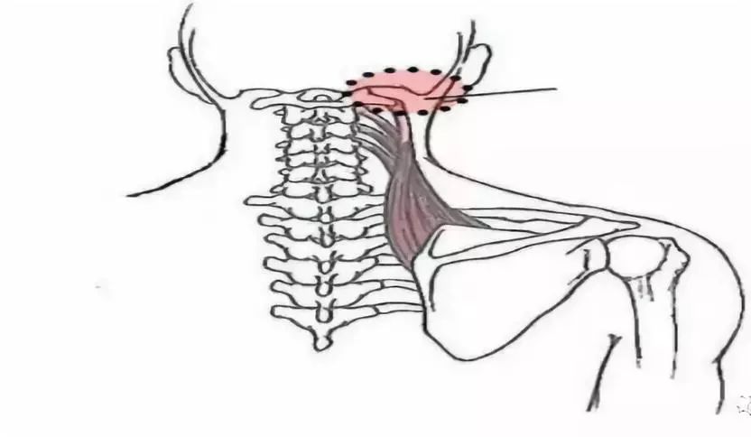 详解颈部肌筋膜性疼痛