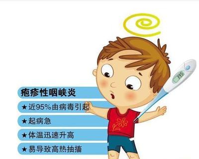 疱疹性咽峡炎是一种由肠道病毒引起的以急性发热和咽峡部疱疹溃疡为
