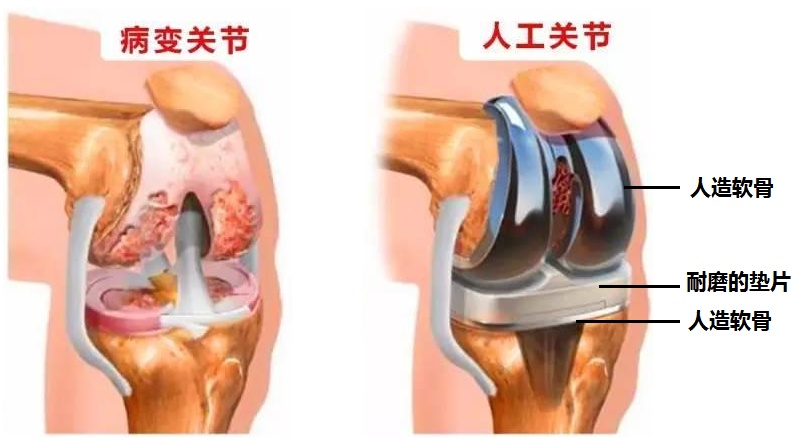 膝关节置换医院排名_膝关节置换图片(2)