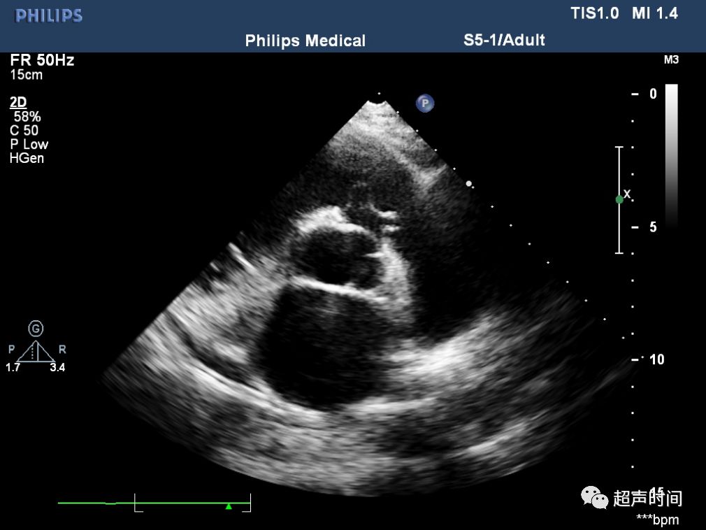 超声典型病例:主动脉右冠窦瘤破入右室