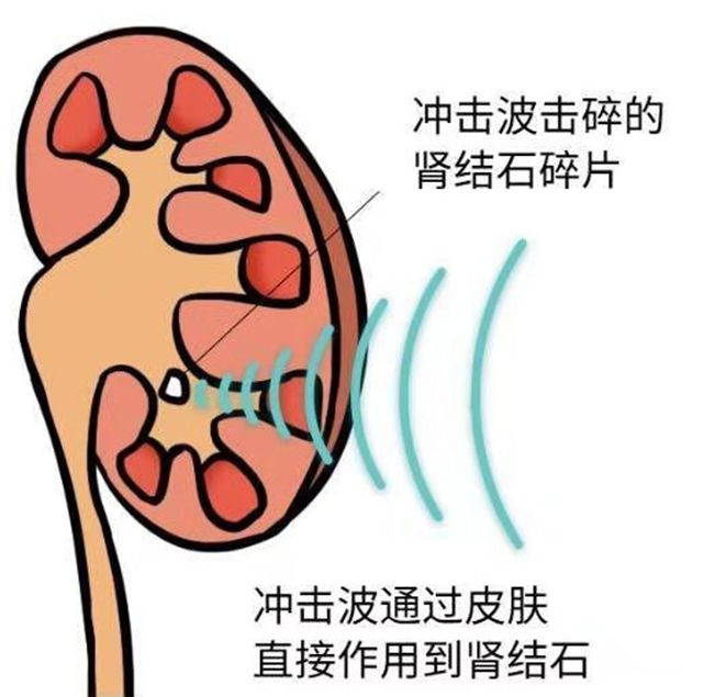 结石药的原理_所以根据我们人自身的生理特点,理论上最大横径为0.6cm以下的结石都可以用药物(2)