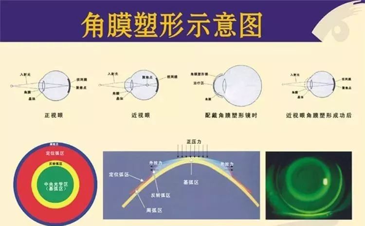 近视镜是运用什么原理_幸福是什么图片