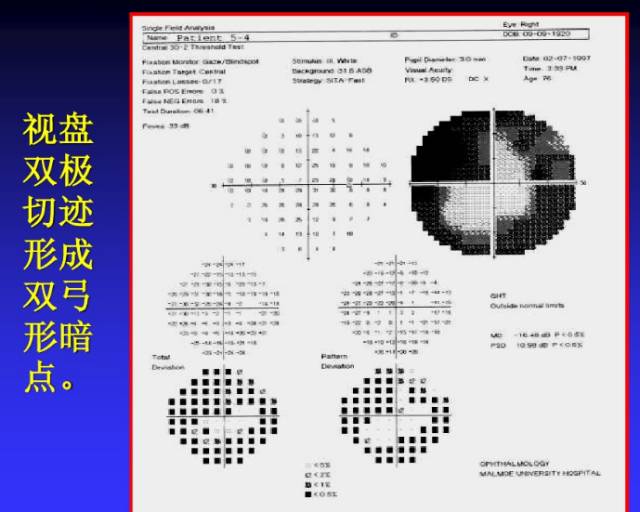 视野检查结果分析基础知识