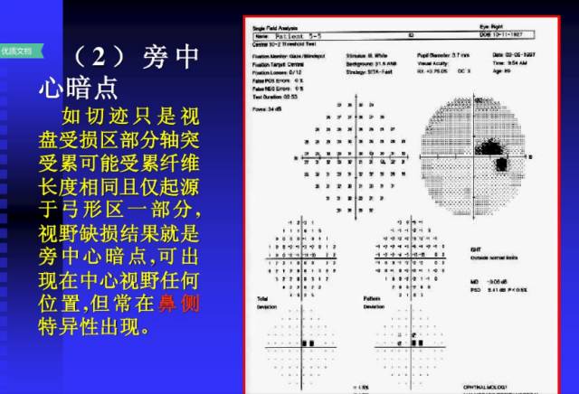 视野检查结果分析基础知识