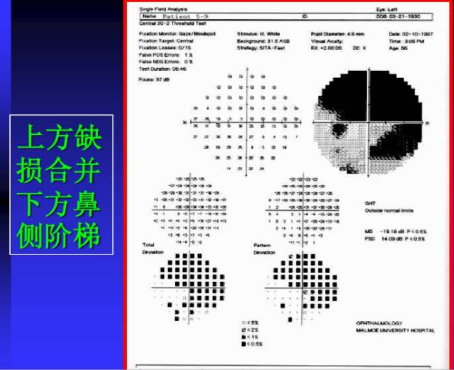 视野检查结果分析基础知识