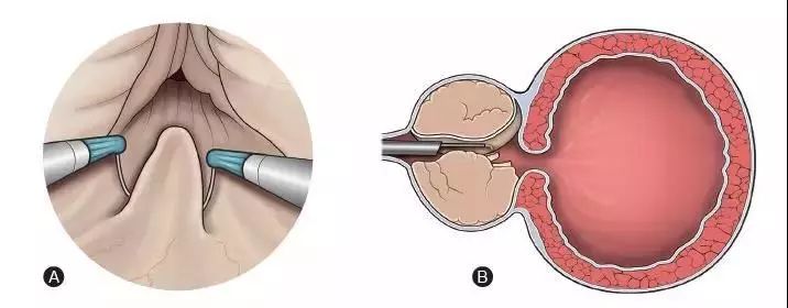 经尿道前列腺电切术
