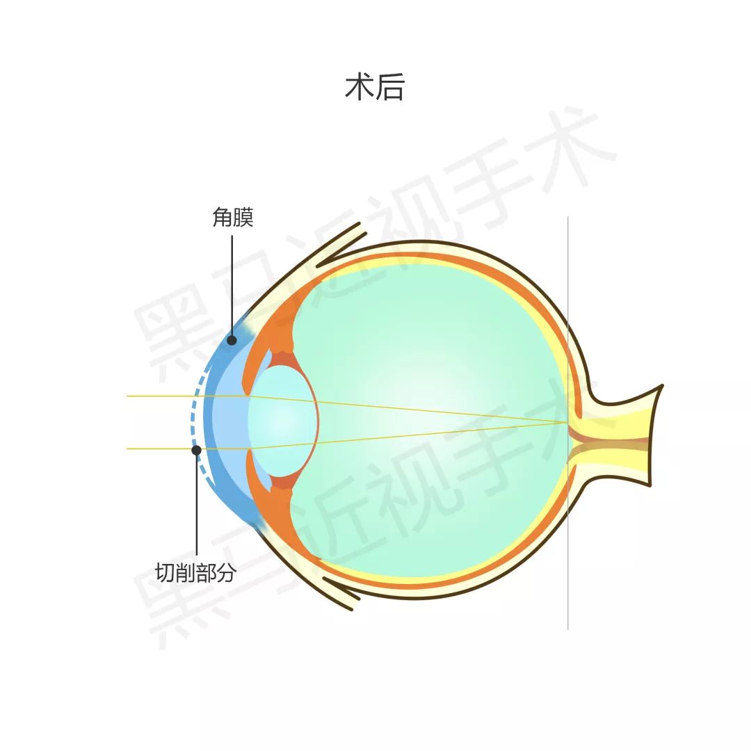 做眼睛近视手术的原理_做近视手术前必须要做眼部检查,医生根据检查的结果,评估你是否适合(2)