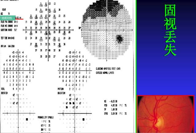 视野检查结果分析基础知识