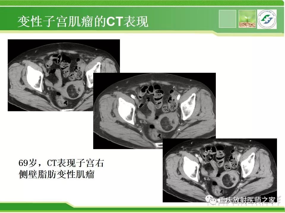 周末学习子宫肌瘤实用影像学诊断