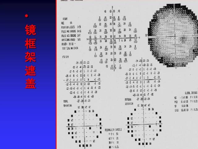 视野检查结果分析基础知识