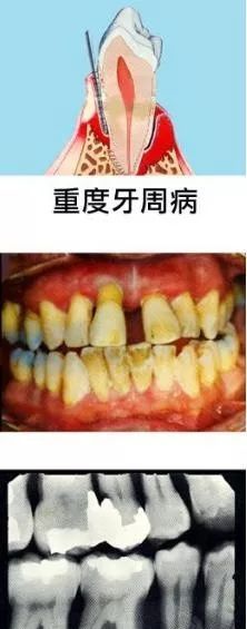 牙龈萎缩,该如何挽救?医生:200元的问题拖到万把块,该