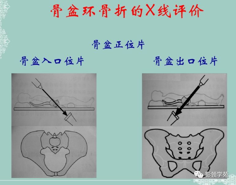 骨盆,髋臼骨折的分型