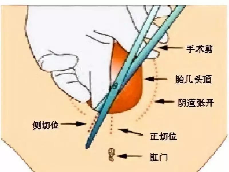 如何避免比生娃时的撕裂和侧切的选择这些技巧孕妈产前一定要学会