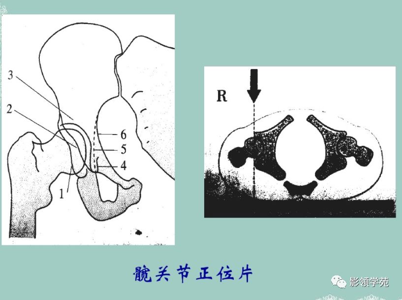 骨盆,髋臼骨折的分型