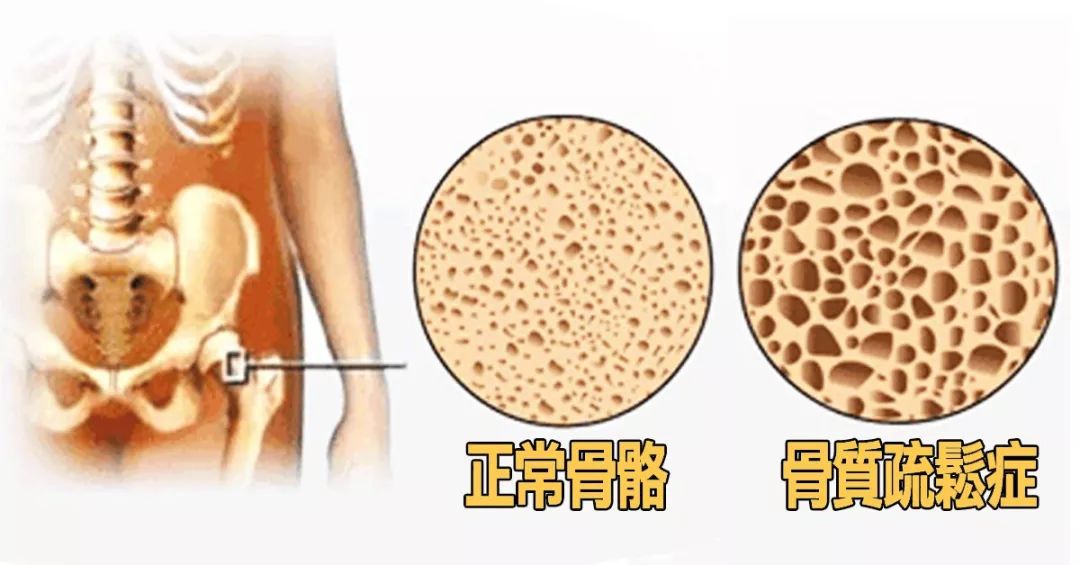 什么原因造成骨质疏松 9be20ac3e1f74992a2c08805d3fadde5.jpeg