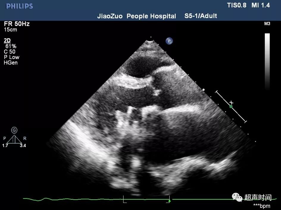 心脏人工瓣膜:有些超声知识点和你想象的不一样_二尖瓣