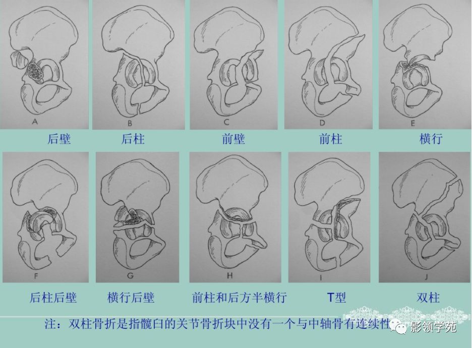 骨盆,髋臼骨折的分型