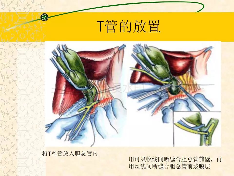 t管引流护理