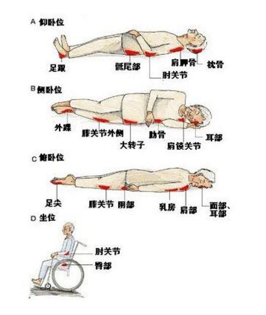 长皮油纱及其他各种外用中药膏粉剂,各期压疮,效果明显,对于骶尾部无