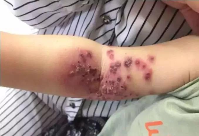 「御众堂产后恢复总部」18个月宝宝被亲吻后身上惨不忍睹！妈妈的吻对宝宝竟然“有毒”？
