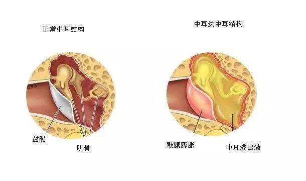 【三院·科普】慢性中耳炎 治疗可不能慢