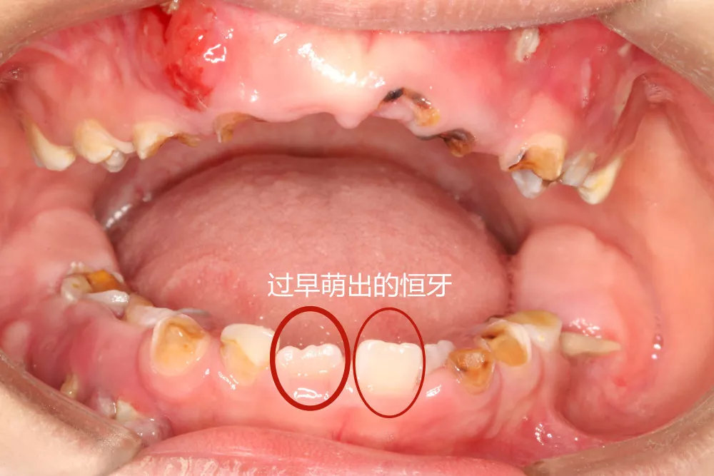 2颗过早萌出的恒牙