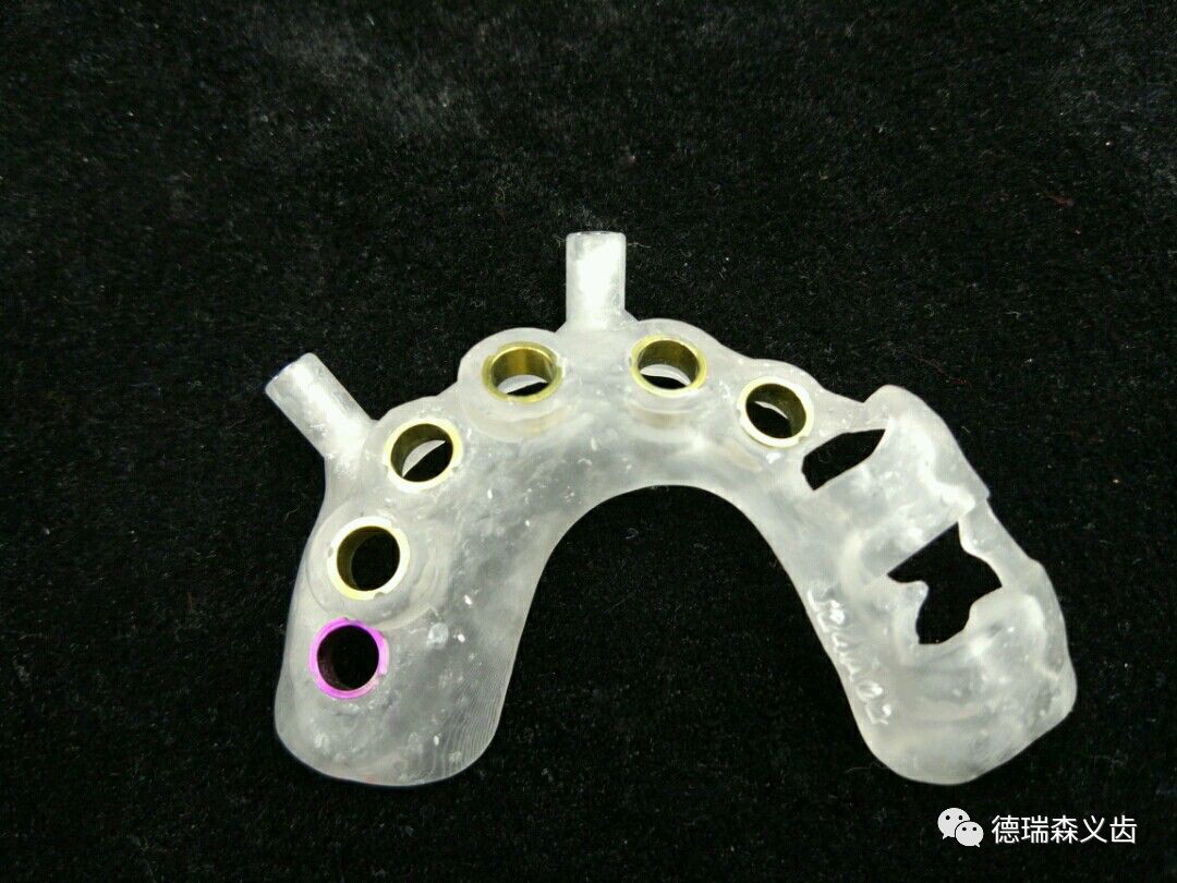 德瑞森种植导板成功病例_手术