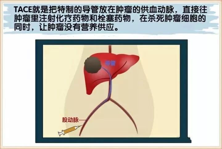 肝癌的介入治疗