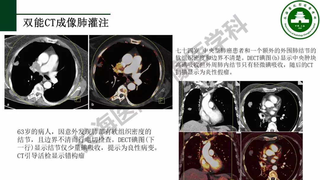 双能量ct原理及临床应用