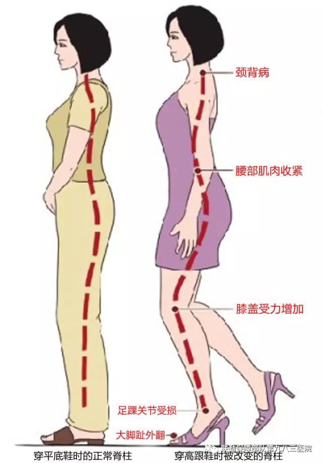 有一种翘臀,叫骨盆前倾,你中招了吗?