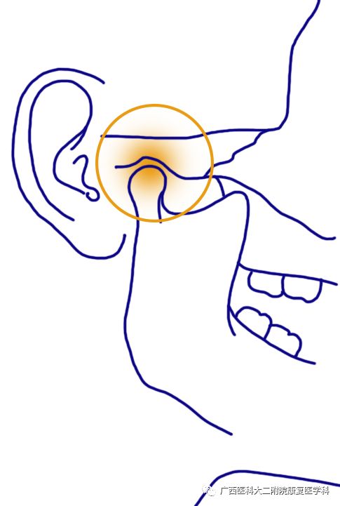 嘴巴张不开?耳朵附近疼痛?小心颞下颌关节紊乱