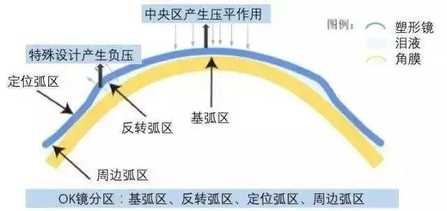 怎么样能减少散光度数 091b02a24c8f43fea74d0ed6de2a4555.jpeg