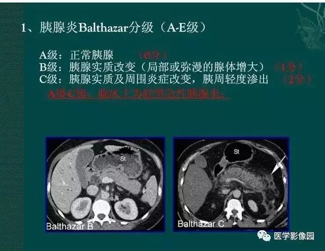 急性胰腺炎ct评价