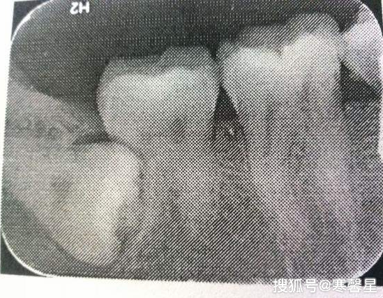 英国一男子在等待拔智齿手术中,因剧痛难忍选