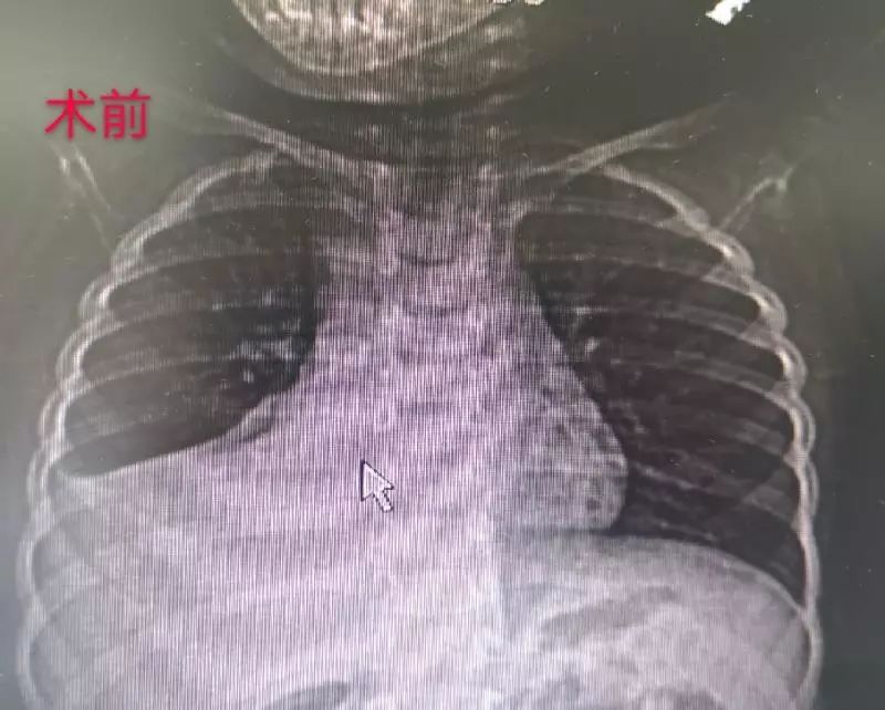 前沿医声孩子得了塑型性支气管炎重症肺炎怎么办看纤