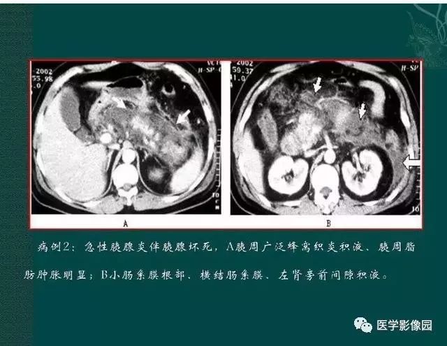 急性胰腺炎ct评价