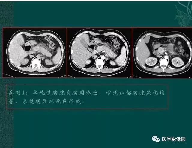 急性胰腺炎ct评价