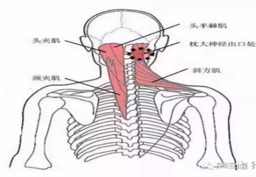 枕大神经出口处为头半棘肌,枕大神经的出口处,枕骨粗隆下,颈项酸痛者