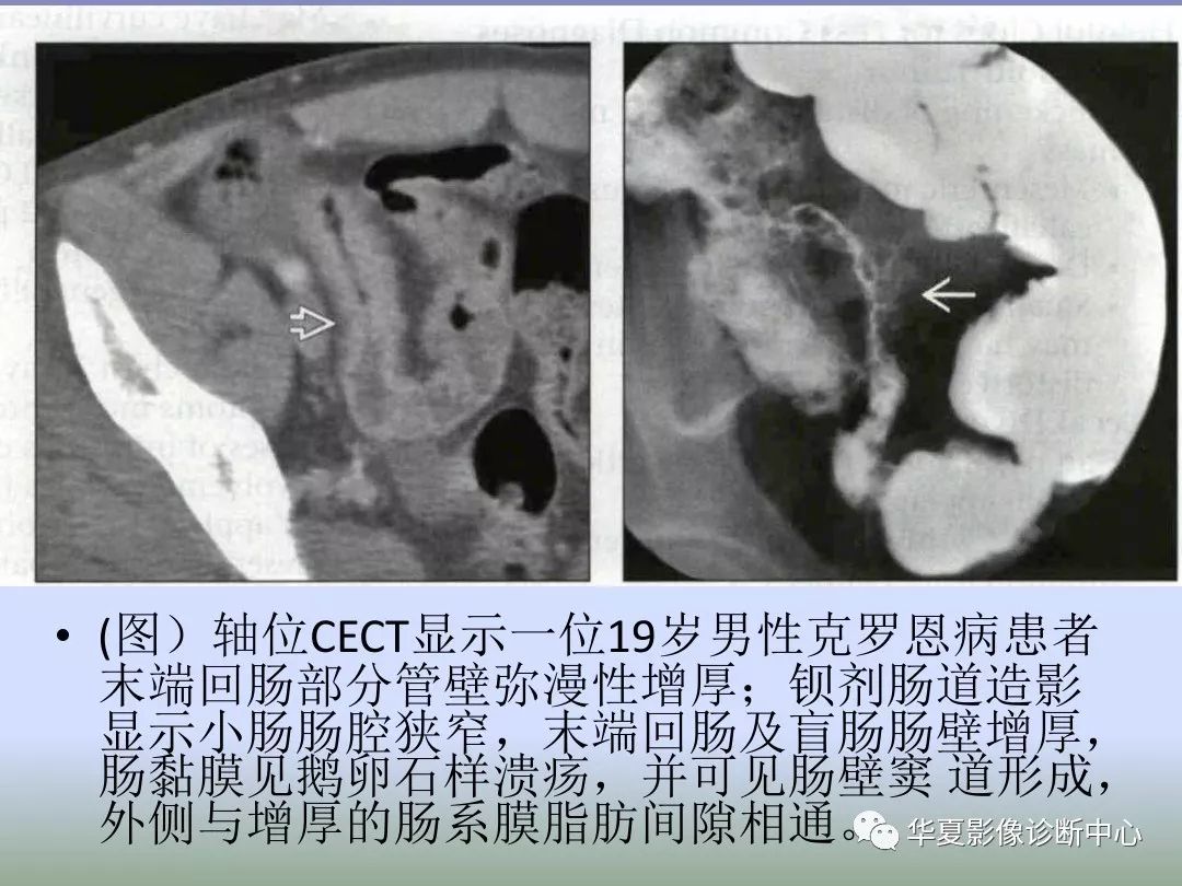 回盲部占位或炎症的影像鉴别诊断