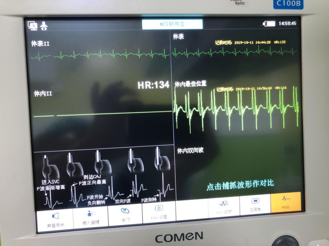 腔内心电图定位导管尖端,打通新生患儿生命要道,这项技术真赞!