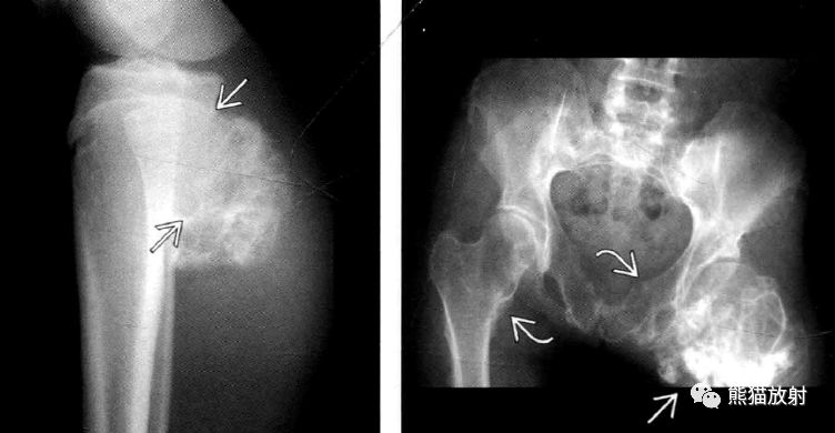长骨干骺端皮质病变丨鉴别诊断