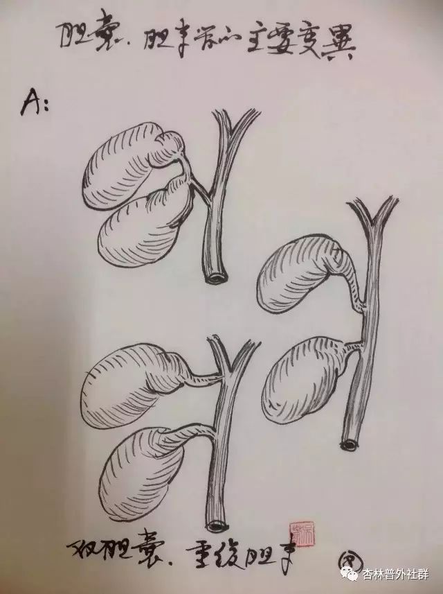 同学们,预习时间到了,专业手绘胆囊解剖,美不美?