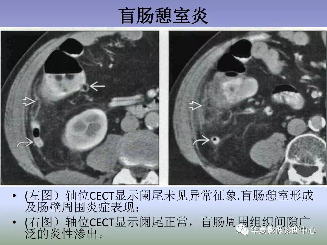 回盲部占位或炎症的影像鉴别诊断