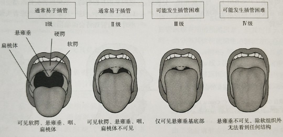 除了产检,您还得找麻醉医生,这评估关键时刻真"救命"!