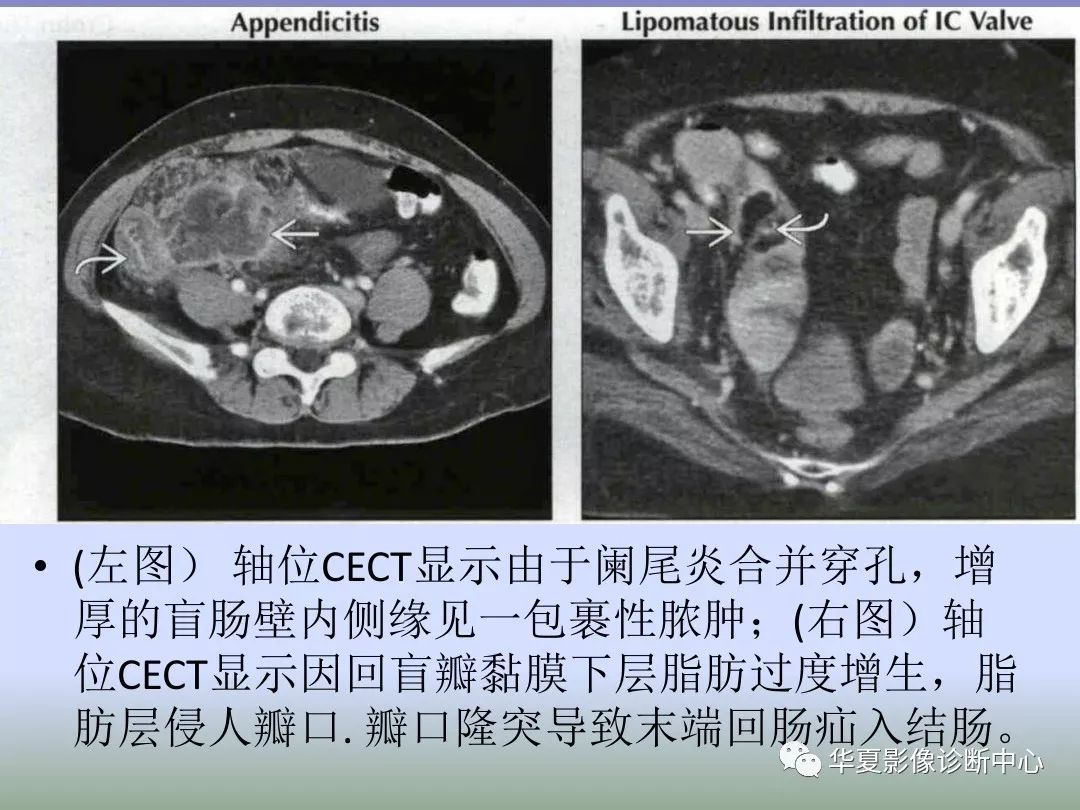 回盲部占位或炎症的影像鉴别诊断