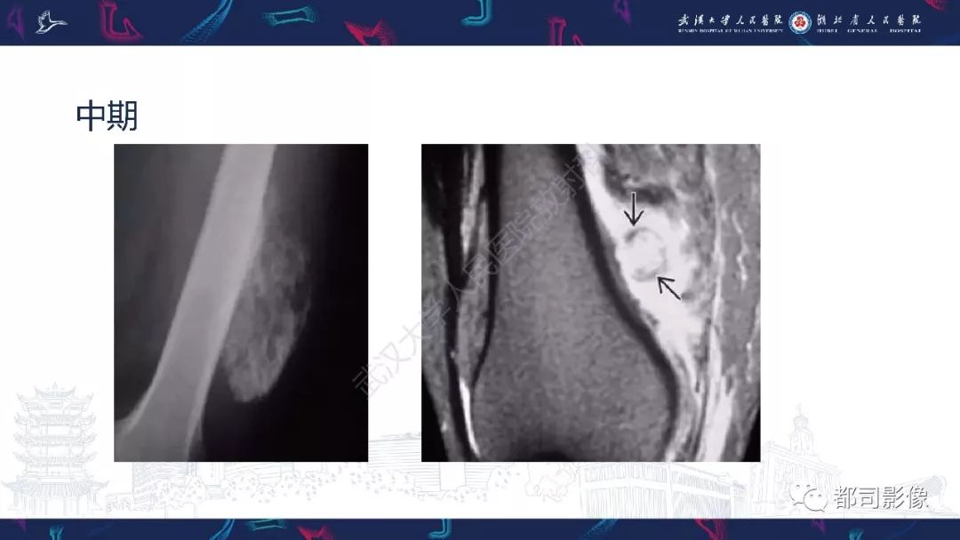 骨旁骨肉瘤影像诊断
